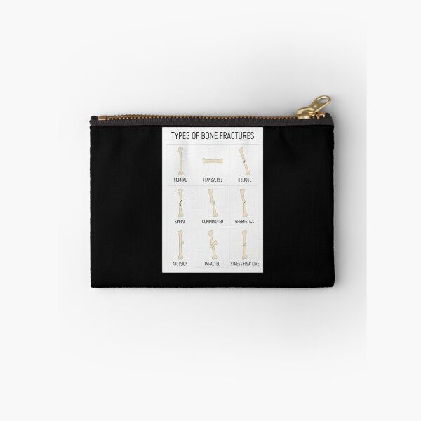 Item preview, Hand Drawn Types of Fractures designed and sold by Shopun.