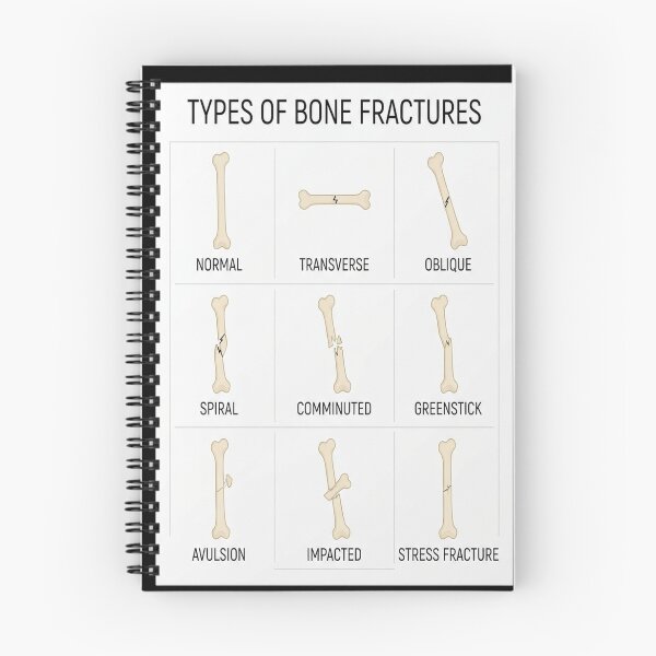 Item preview, Hand Drawn Types of Fractures designed and sold by Shopun.