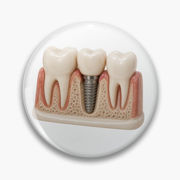Item preview, Dental Implant3d Cross Section – Tooth Replacement with Titanium Implant, Abutment and Crown designed and sold by RokaCircles.