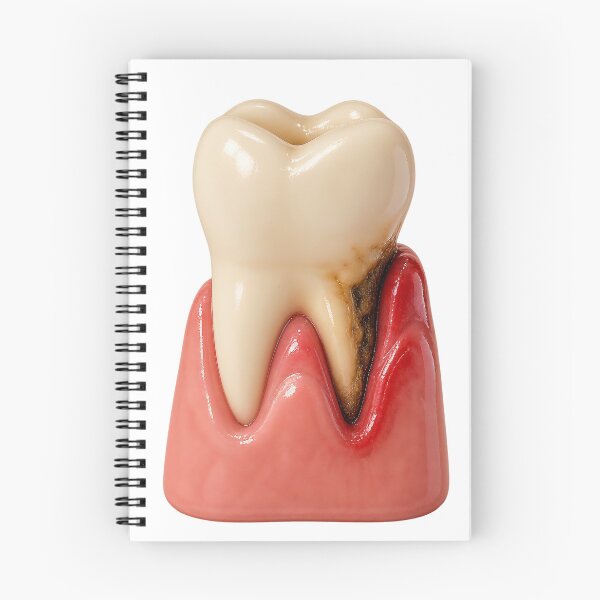 Item preview, Gum Pocket and Tooth Decay – Periodontal Pocket and Root Caries Medical Illustration  S designed and sold by RokaCircles.