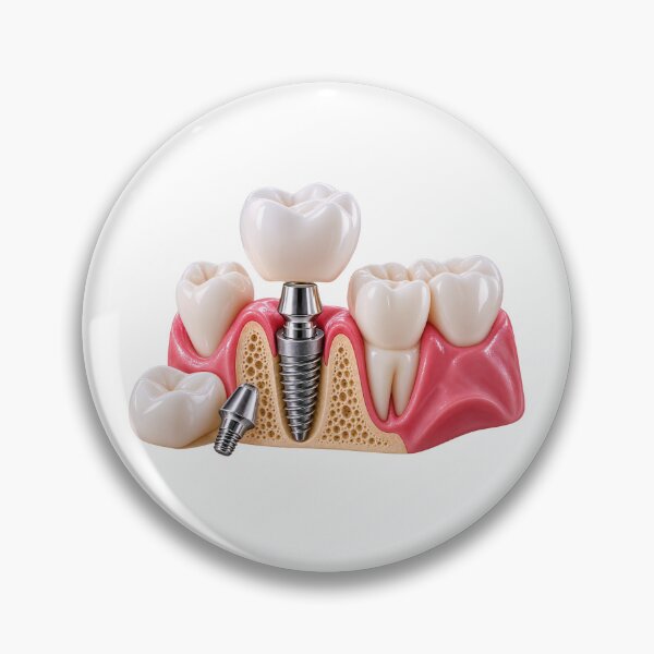 Item preview, Dental Implant Components and Restoration – Titanium Implant, Abutment and Crown in Jawbone designed and sold by RokaCircles.