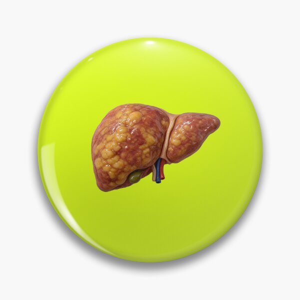 Item preview, Fatty Liver Disease Anatomy – Realistic Human Liver Medical Illustration designed and sold by RokaCircles.