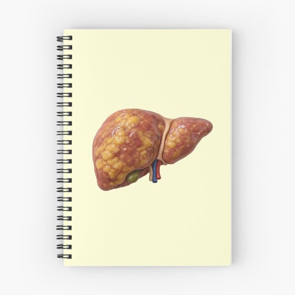 Item preview, Fatty Liver Disease Anatomy – Realistic Human Liver Medical Illustration designed and sold by RokaCircles.