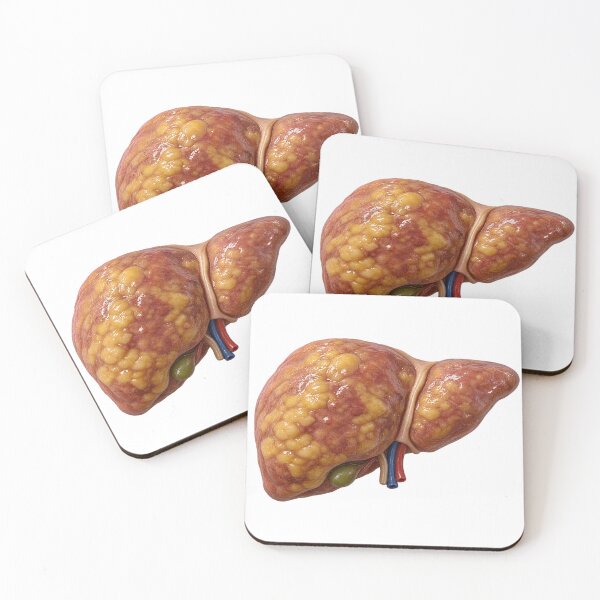 Item preview, Fatty Liver Disease Anatomy – Realistic Human Liver Medical Illustration designed and sold by RokaCircles.