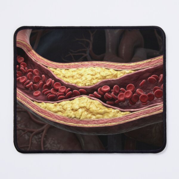 Item preview, Clogged Artery Yellow Plaque Cross Section designed and sold by KaiWaiGallery.