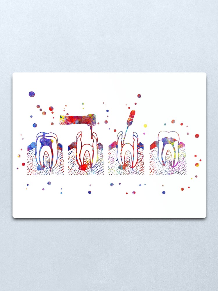 Alternate view of The root canal therapy, the root canal, root canal treatment Metal Print