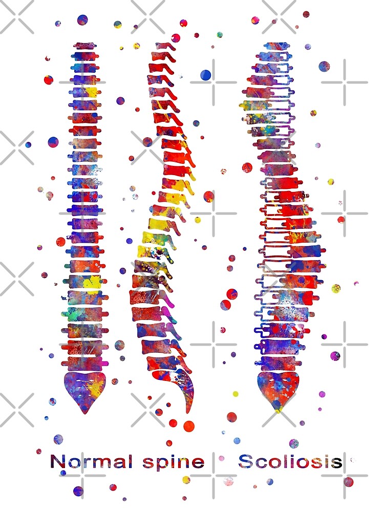  spine normal spine scoliosis abnormal lateral curvature of the
