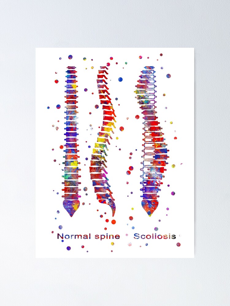  spine normal spine scoliosis abnormal lateral curvature of the