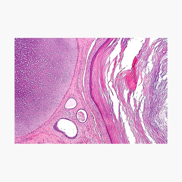 Vista previa del artículo con la obra «Histología del teratoma», diseñado y vendido por deltoid.