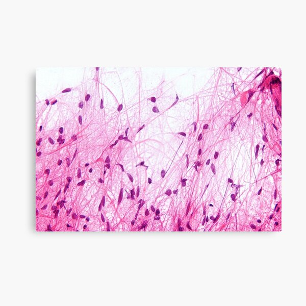 Aperçu de l'œuvre Histologie de l'astrocytome créée et vendue par deltoid.