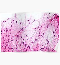 Astrocytoma Histology Poster