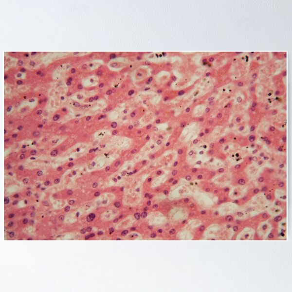 Item preview, Human liver cells with tuberculosis under the microscope. designed and sold by Zosimus.