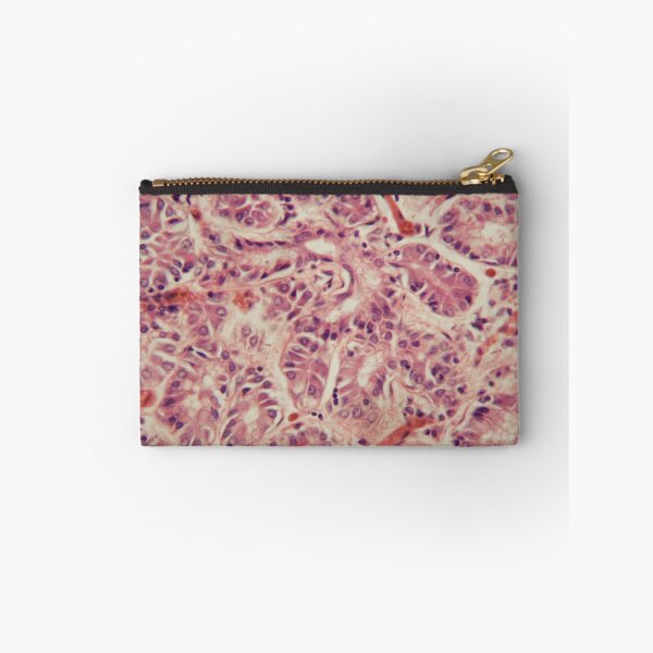 Item preview, Human lung tissue with Pulmonary embolism under a microscope. designed and sold by Zosimus.