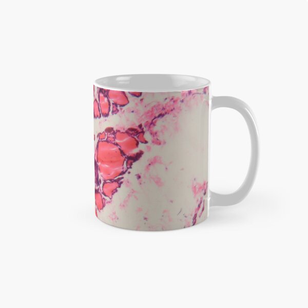 Item preview, Cells of a human thyroid gland with goiter caused by deficiency of iodine under a microscope. designed and sold by Zosimus.