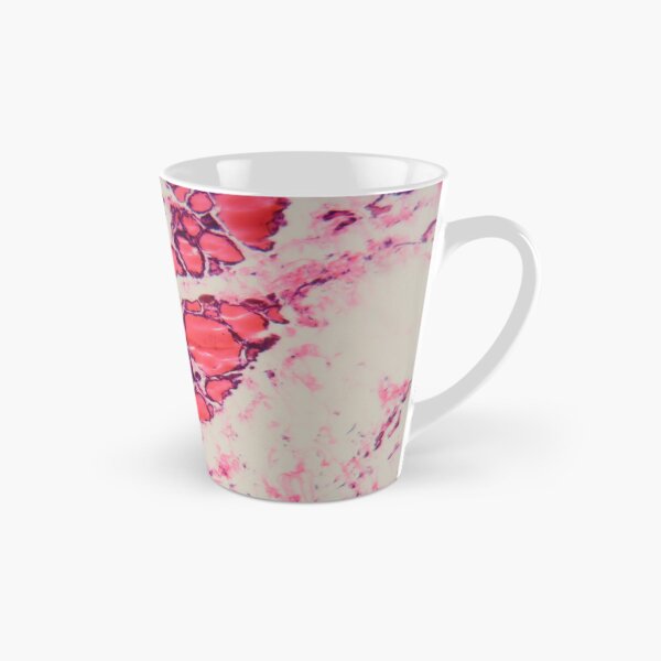 Item preview, Cells of a human thyroid gland with goiter caused by deficiency of iodine under a microscope. designed and sold by Zosimus.