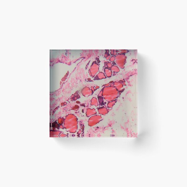 Item preview, Cells of a human thyroid gland with goiter caused by deficiency of iodine under a microscope. designed and sold by Zosimus.
