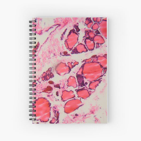 Item preview, Cells of a human thyroid gland with goiter caused by deficiency of iodine under a microscope. designed and sold by Zosimus.