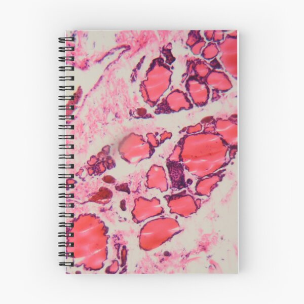 Item preview, Cells of a human thyroid gland with goiter caused by deficiency of iodine under a microscope. designed and sold by Zosimus.
