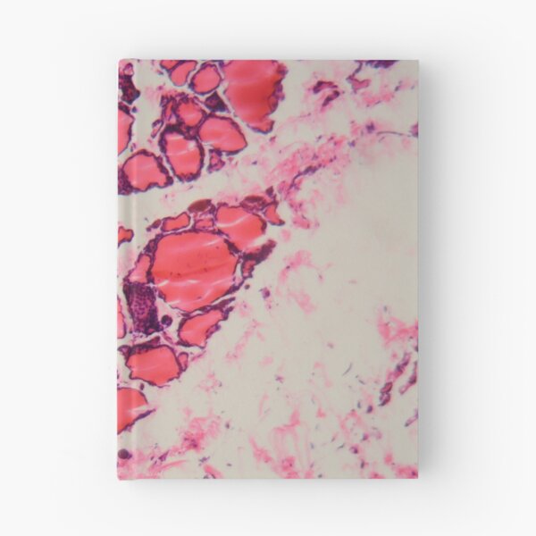 Item preview, Cells of a human thyroid gland with goiter caused by deficiency of iodine under a microscope. designed and sold by Zosimus.