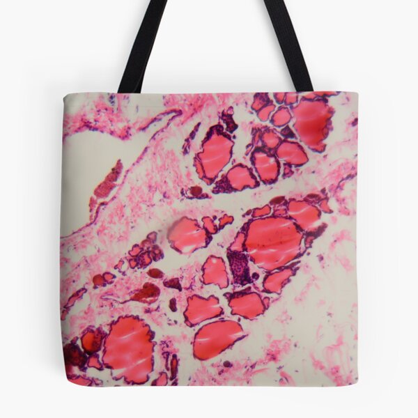 Item preview, Cells of a human thyroid gland with goiter caused by deficiency of iodine under a microscope. designed and sold by Zosimus.