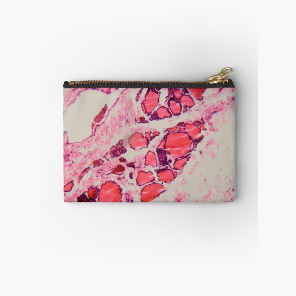 Item preview, Cells of a human thyroid gland with goiter caused by deficiency of iodine under a microscope. designed and sold by Zosimus.