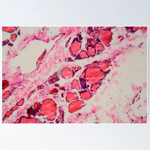 Item preview, Cells of a human thyroid gland with goiter caused by deficiency of iodine under a microscope. designed and sold by Zosimus.