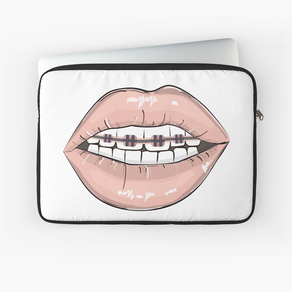 Lips braces