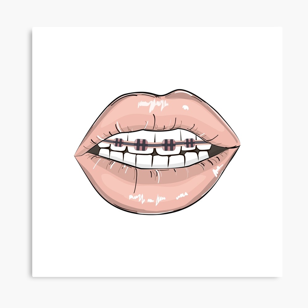 Lips braces