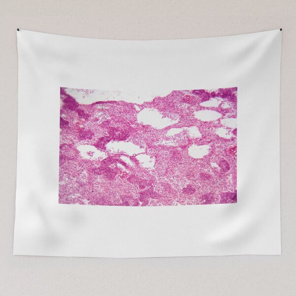 Item preview, Lymph node cells under the microscope. designed and sold by Zosimus.
