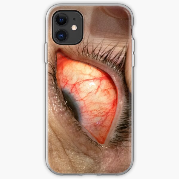 Zombie Eye iPhone Soft Case