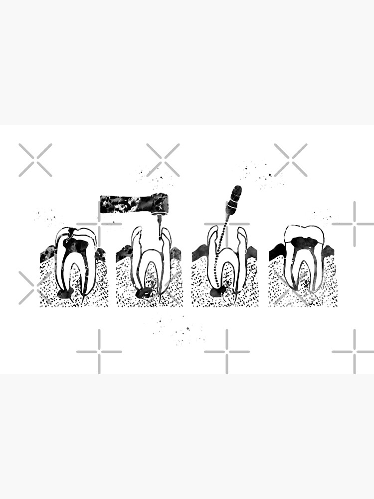 The root canal therapy by erzebetth