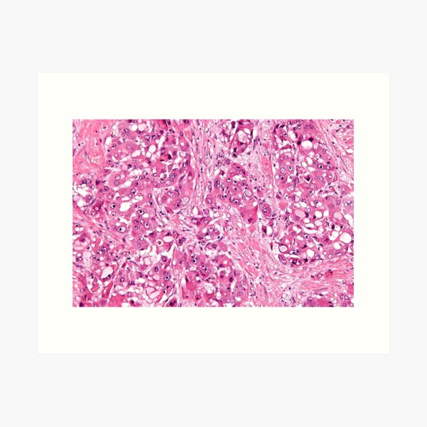 Aperçu de l'œuvre Histologie du cancer du foie créée et vendue par deltoid.