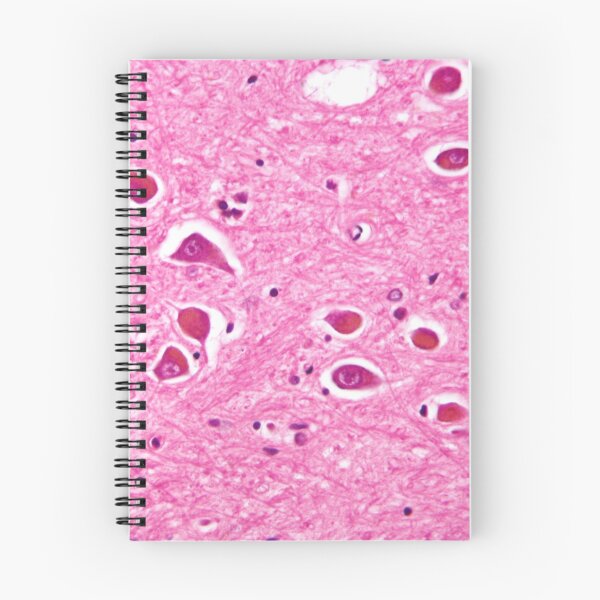Item preview, Alzheimers Disease Histology designed and sold by deltoid.