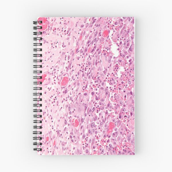 Item preview, Sarcoma Histology designed and sold by deltoid.