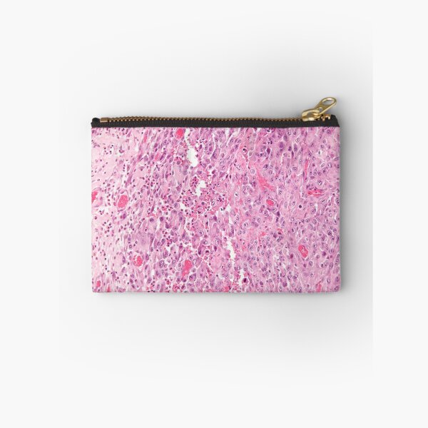 Item preview, Sarcoma Histology designed and sold by deltoid.