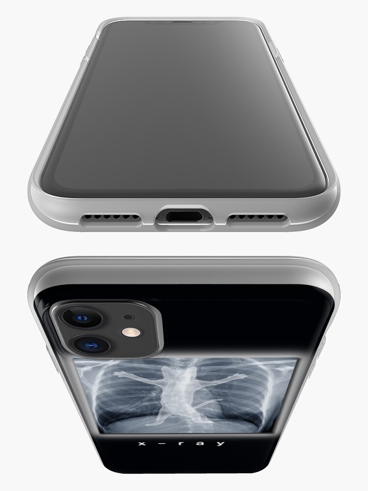"Xray" iPhone Case & Cover by tummeow Redbubble