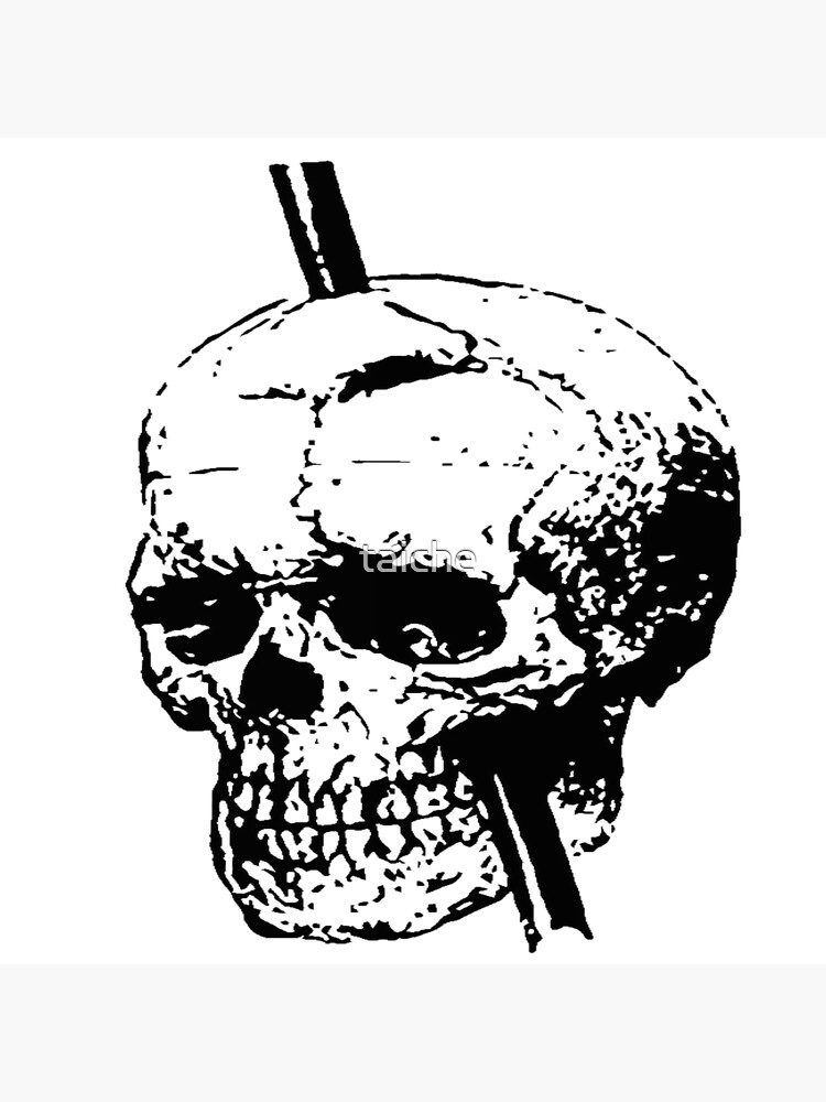 "Skull of Phineas Gage With Tamping Iron" Poster by taiche Redbubble