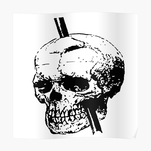 Skull With Tamping Iron Diagram Front And Lateral View Poster