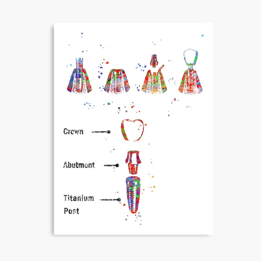 Dental implant procedure, dental anatomy, dental implant Canvas Print