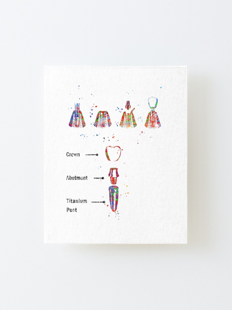 Alternate view of Dental implant procedure, dental anatomy, dental implant Mounted Print