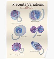 Placenta Variations Teaching Poster