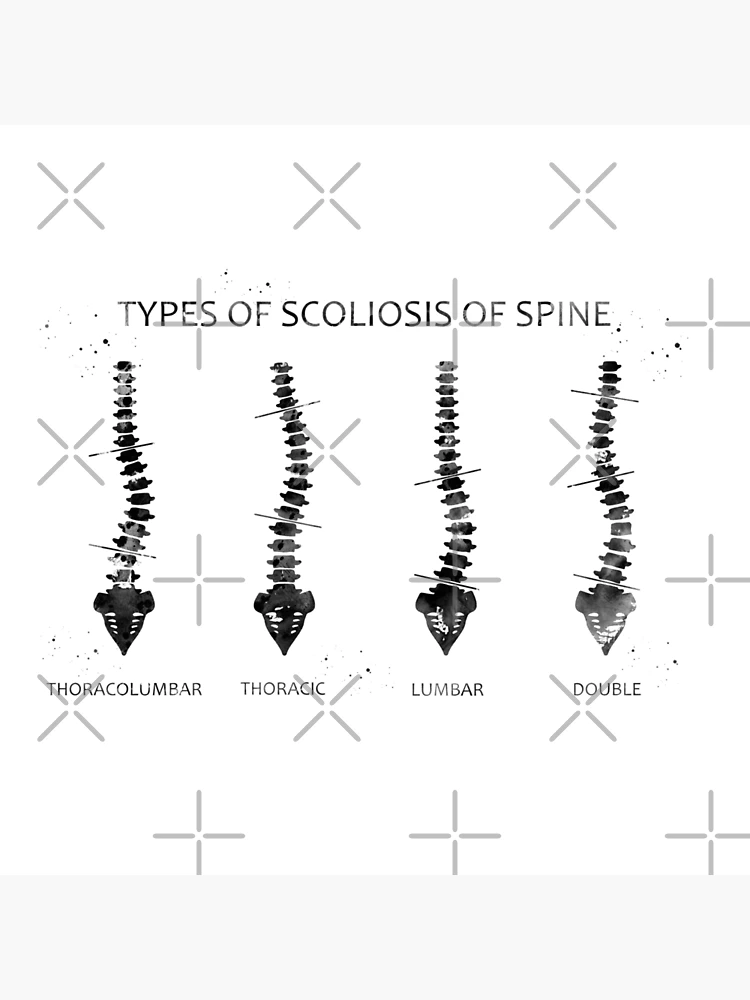 Type of scoliosis of spine Throw Pillow for Sale by Rosaliartbook