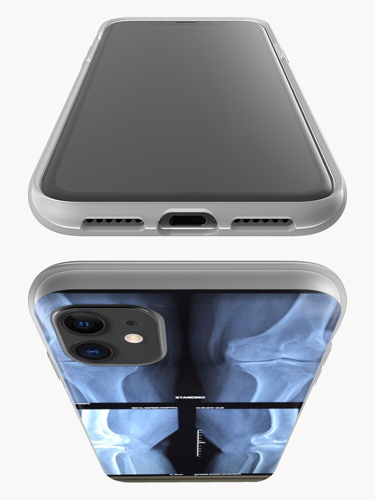 "Xray" iPhone Case & Cover by ibrahimov Redbubble