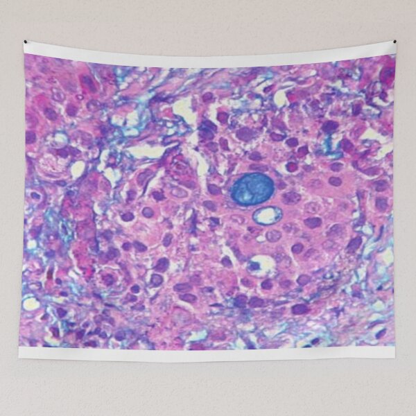 Item preview, Mucoepidermoid carcinoma designed and sold by DarkiraVClemm.