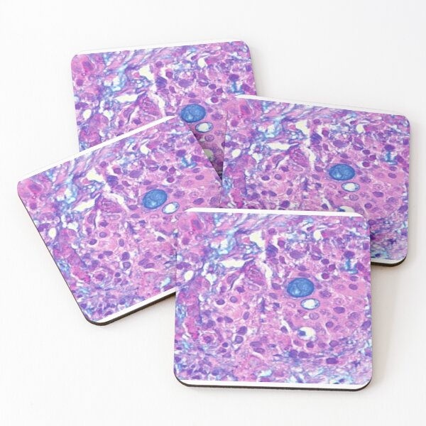 Item preview, Mucoepidermoid carcinoma designed and sold by DarkiraVClemm.