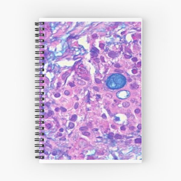 Item preview, Mucoepidermoid carcinoma designed and sold by DarkiraVClemm.
