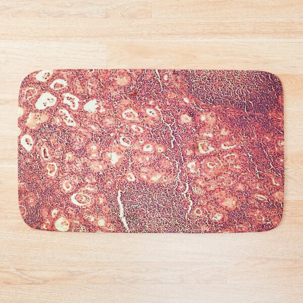 Item preview, Hashimoto's thyroiditis designed and sold by DarkiraVClemm.