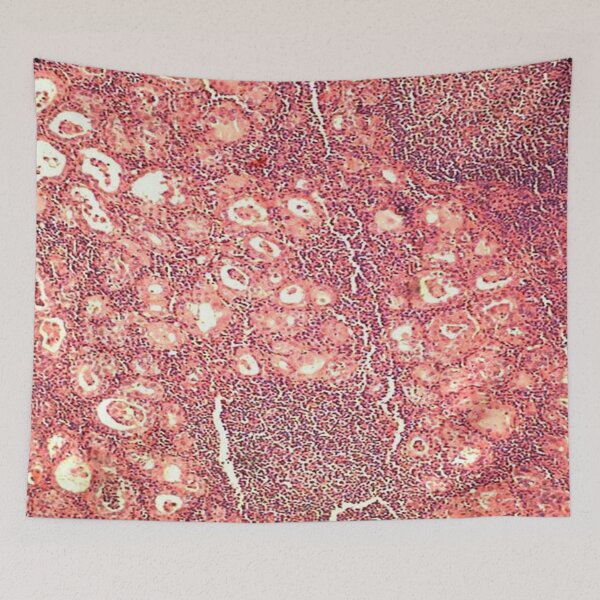 Item preview, Hashimoto's thyroiditis designed and sold by DarkiraVClemm.
