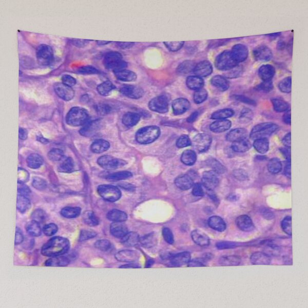 Item preview, Papillary carcinoma designed and sold by DarkiraVClemm.