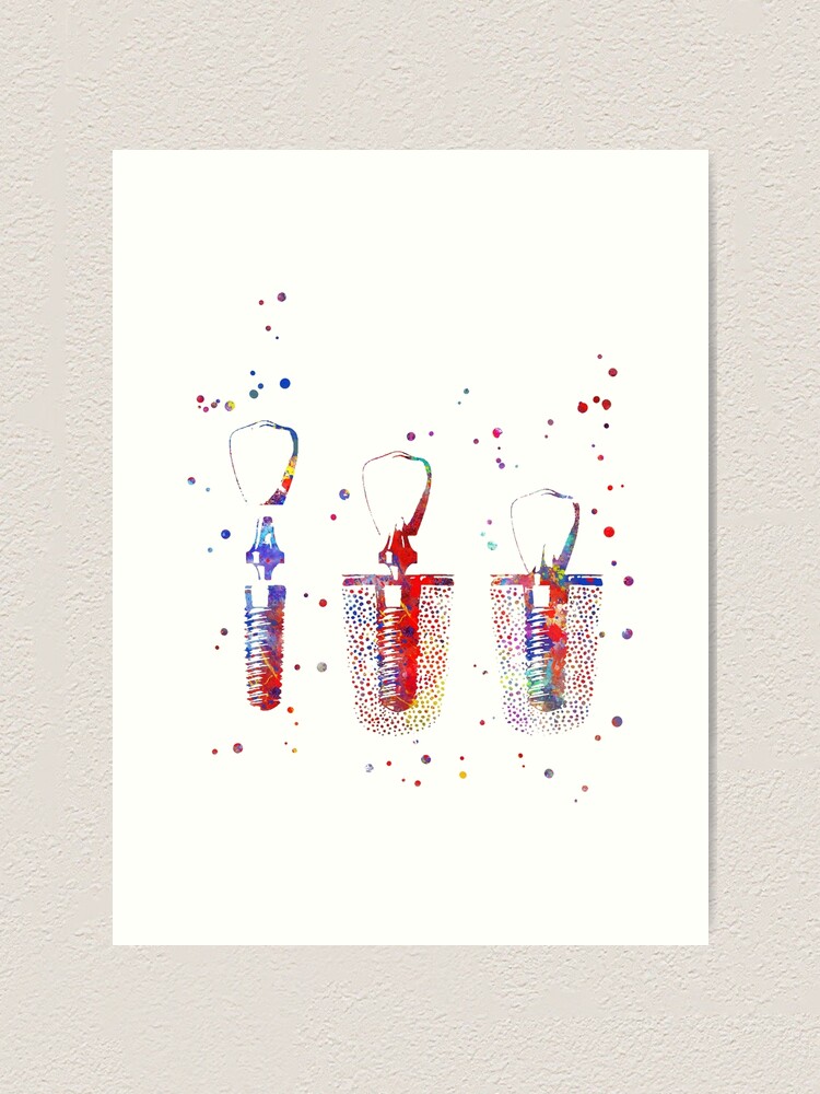 "Dental implant procedure, dental anatomy" Art Print by Rosaliartbook